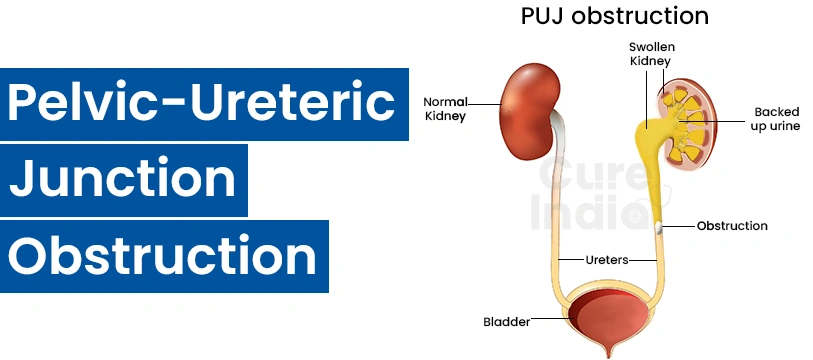 What is PUJ Obstruction?